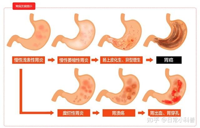 从胃炎到胃癌，只有4步！出现这些症状，别不当回事儿。