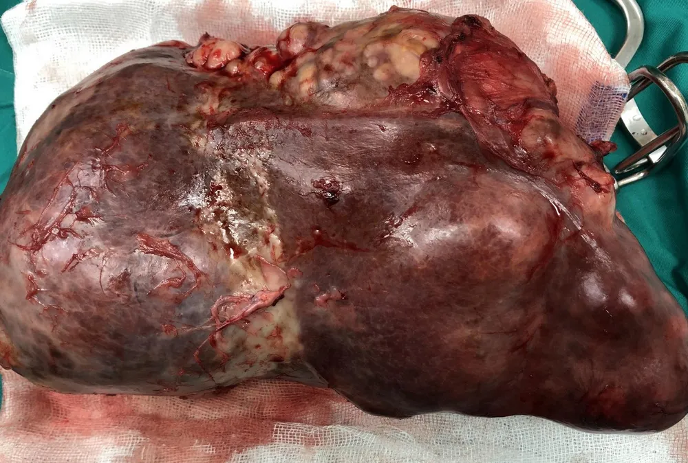 Phẫu thuật cắt thành công khối u lá lách gần 3kg ảnh 2