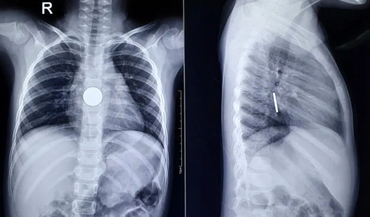 Gắp thành công đồng xu trong người bé gái 6 tuổi ảnh 2