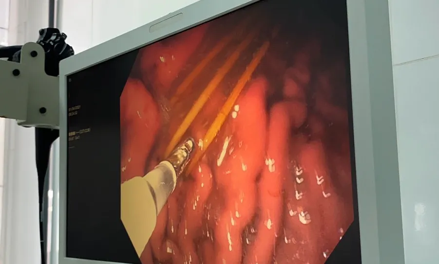 Ngủ quên, nuốt 3 cây tăm tre vào bụng ảnh 1