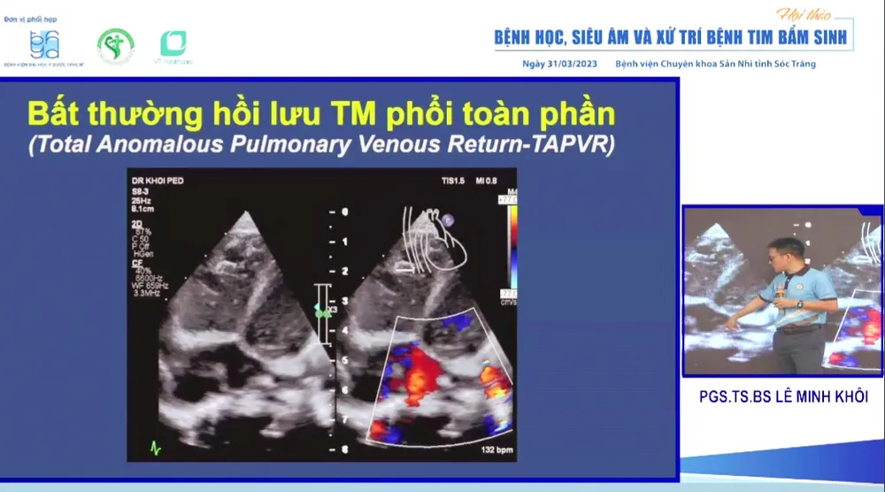 PGS-TS-BS Lê Minh Khôi trình bày tại hội thảo “Bệnh học, siêu âm và xử trí bệnh tim bẩm sinh”