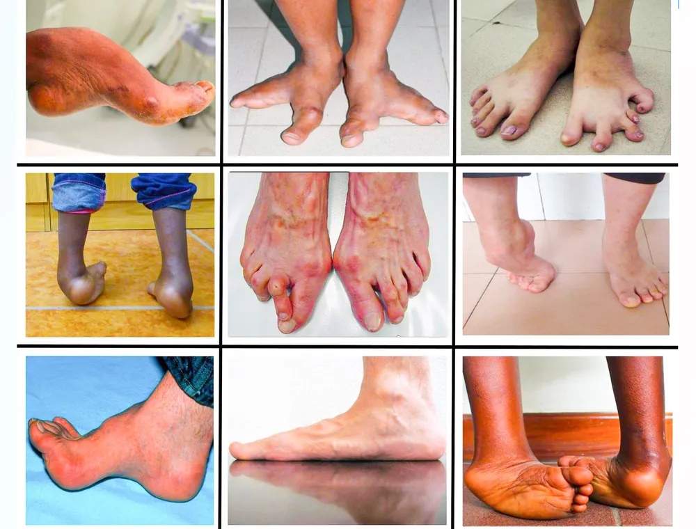 Một số bị dị tật cổ bàn chân phổ biến