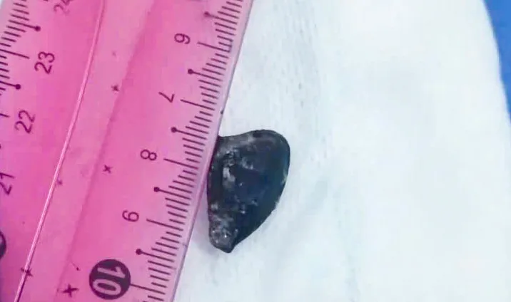 Hạt sapôchê trong phế quản người đàn ông được các bác sĩ lấy ra