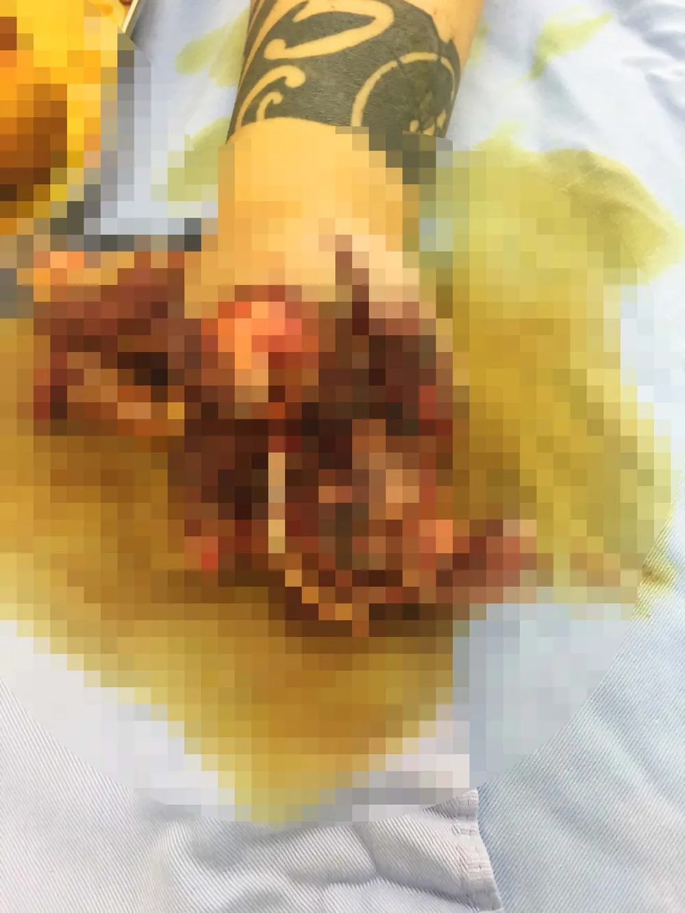 Vật nghi lựu đạn phát nổ, người phụ nữ bị nát bàn tay ảnh 1