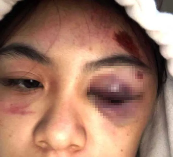 Nữ sinh bị đánh hội đồng trên đường đến trường tiêm vaccine ảnh 2