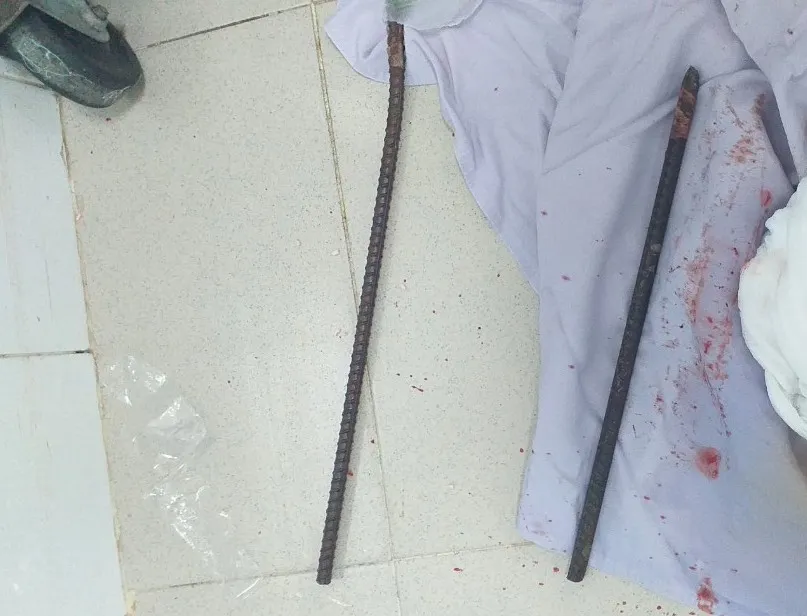 2 thanh sắt lớn được lấy ra khỏi cơ thể nạn nhân