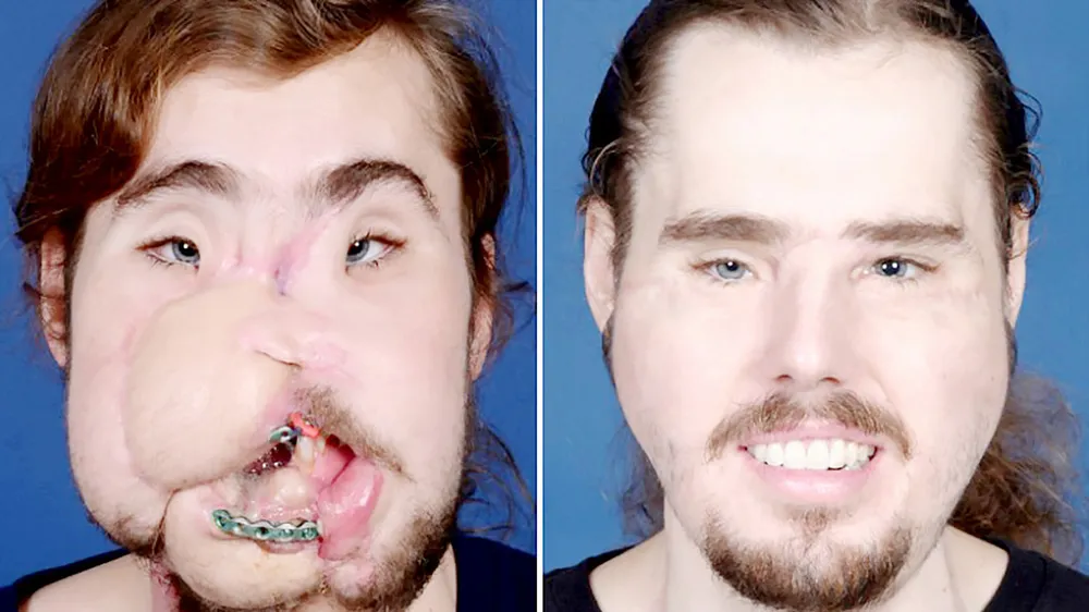 Người ghép mặt xuất hiện trước công chúng