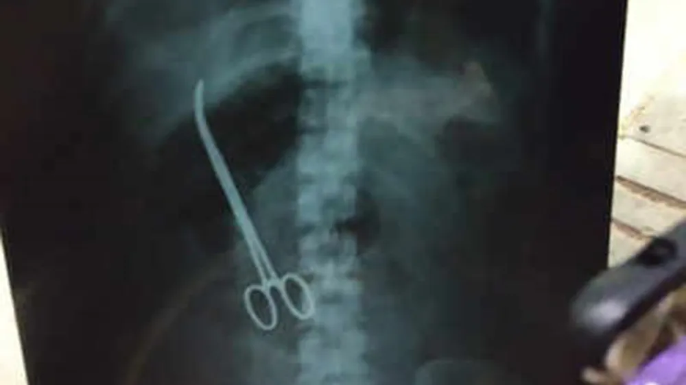 Lấy kéo bỏ quên trong ổ bụng bệnh nhân