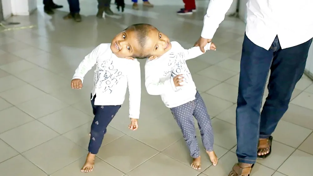 Bangladesh: Tách thành công cặp song sinh dính nhau phần đầu