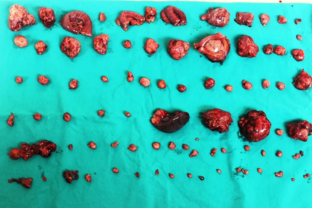 Các khối u được phẫu thuật lấy ra khỏi cơ thể bệnh nhân 