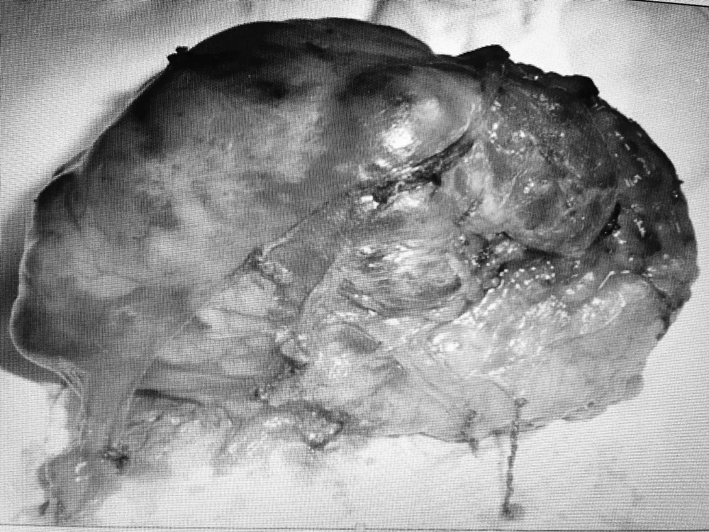 Khối u sau khi được lấy ra khỏi cơ thể bệnh nhân