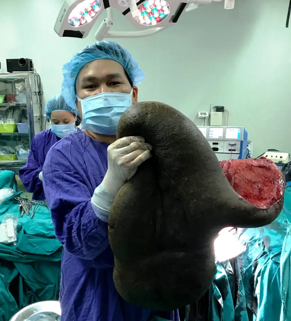 Chàng trai mang chiếc “mai rùa” suốt 26 năm được giải thoát kỳ diệu ảnh 2