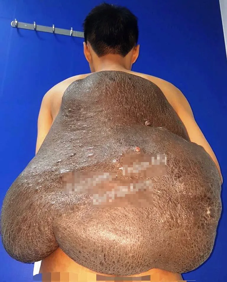 Chàng trai mang chiếc “mai rùa” suốt 26 năm được giải thoát kỳ diệu ảnh 1