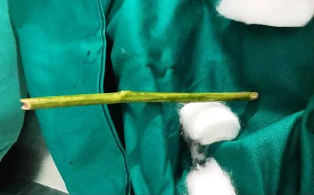 Kinh hoàng: tử vong sau khi dùng que nứa phá thai  ảnh 1