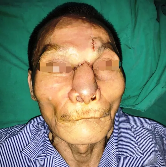 Tái tạo thành công mũi, má cho bệnh nhân bị ung thư biến dạng khuôn mặt ảnh 1