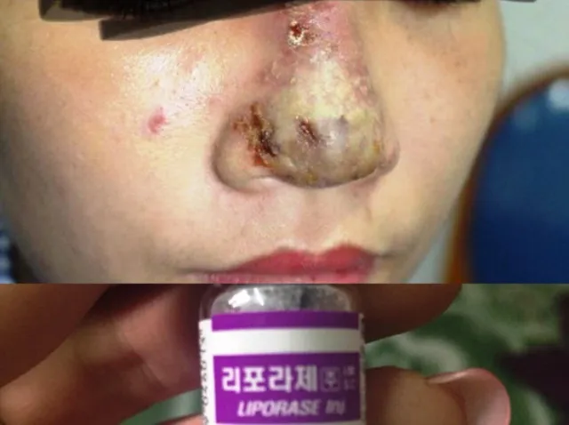 Kinh hoàng mũi bị hoại tử sau tiêm filler nâng mũi  ảnh 1