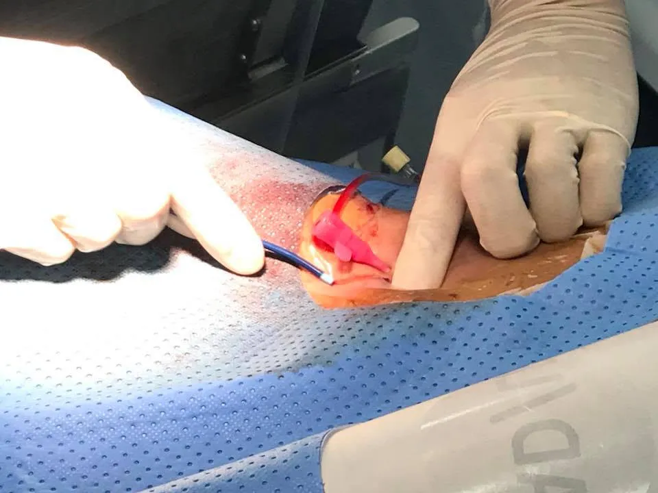  4 trẻ dị tật tim được can thiệp bằng DSA ảnh 2