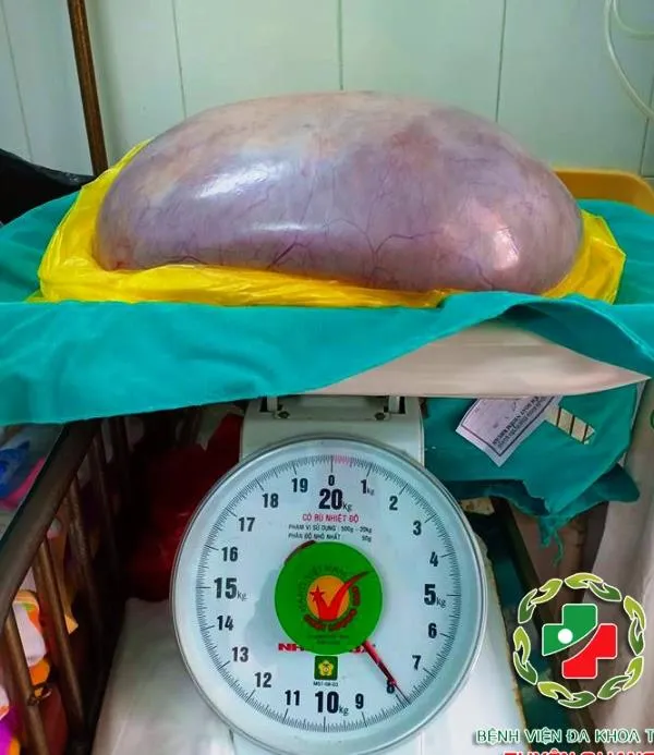 Thiếu nữ 22 tuổi “đốt ngải” để trị khối u buồng trứng gần 8 kg ảnh 2