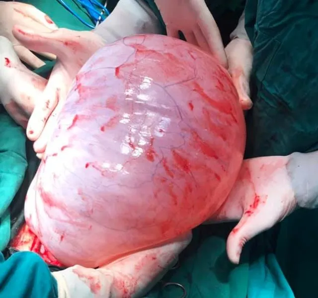 Thiếu nữ 22 tuổi “đốt ngải” để trị khối u buồng trứng gần 8 kg ảnh 1