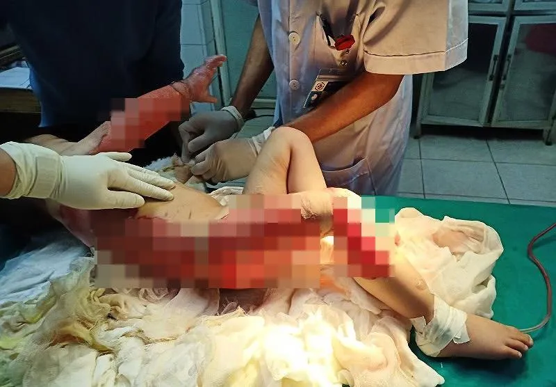 Nhiều trẻ nhỏ bị tuột hết da do bỏng nước sôi ảnh 1