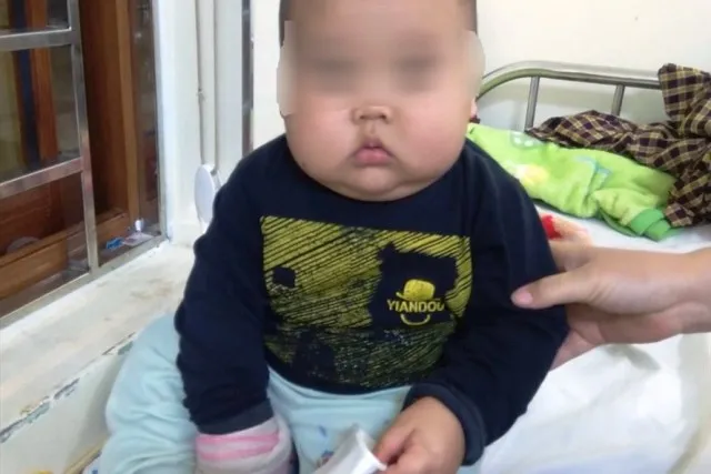 Uống thuốc có Corticoid, bé trai 17 tháng tuổi tăng 3 kg nhưng  bị suy thận cấp! ảnh 1