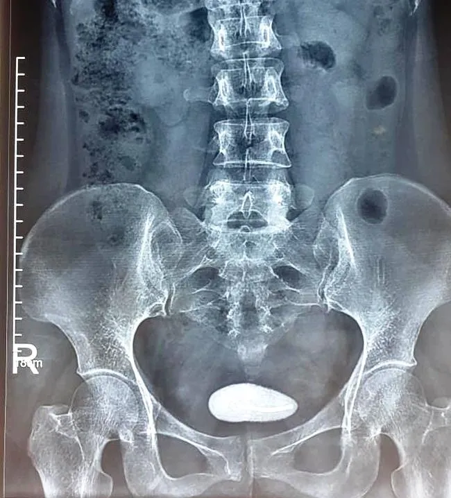 Vòng tránh thai đi lạc vào bàng quang tạo ra sỏi khủng ảnh 1