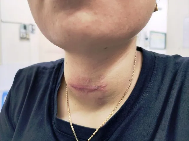 Nhiễm trùng loét cổ vì hơ nhang, đắp lá chữa bệnh basedow ảnh 2