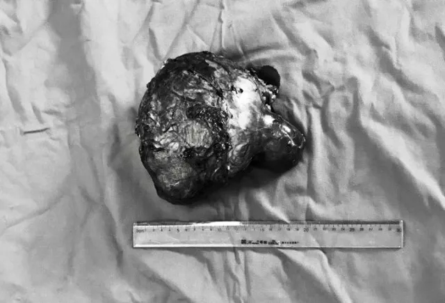 Phẫu thuật thành công khối u thận “khủng” ở bé gái 6 tuổi ảnh 3