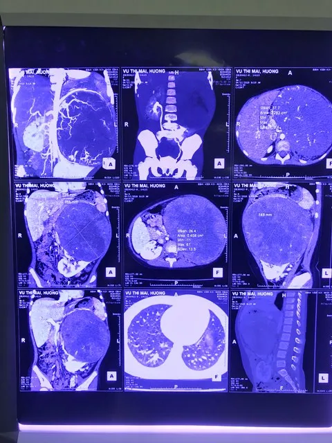 Phẫu thuật thành công khối u thận “khủng” ở bé gái 6 tuổi ảnh 1