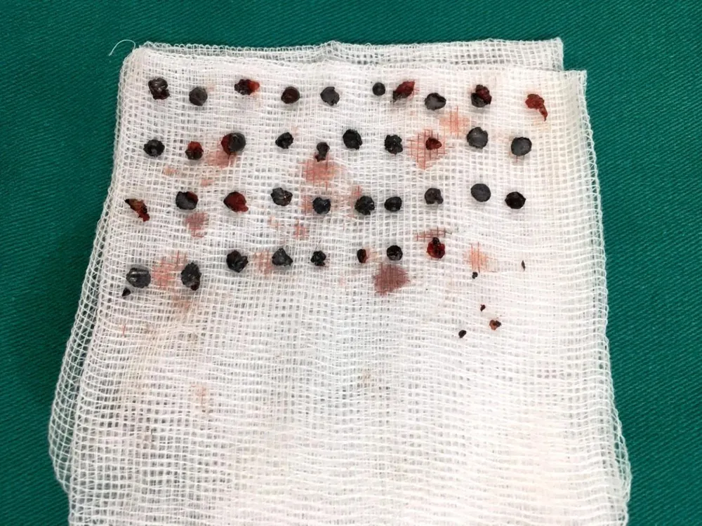  Nam thanh niên bị trúng 50 viên đạn hoa cải trong lúc ẩu đả ảnh 2