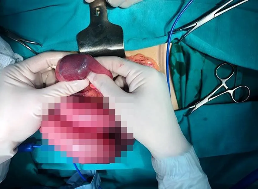 Ruột vón cục như nhựa đường vì thường xuyên uống trà sữa ảnh 1