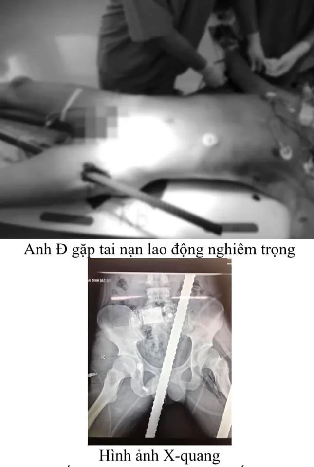 Nam thanh niên bị 2 thanh sắt đâm xuyên tầng sinh môn, bụng, ngực, đùi ảnh 1