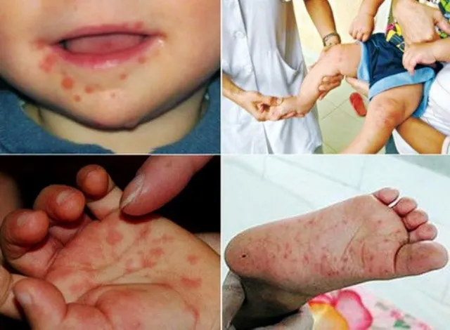 Gần 11.000 ca mắc tay chân miệng, Bộ Y tế khẩn cấp yêu cầu giảm tối đa số ca mắc và tử vong ảnh 1