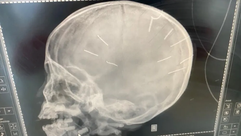 Bé gái bị 9 chiếc đinh ghim vào đầu tiên lượng nặng, công an ráo riết điều tra ảnh 1