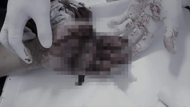 Nam thanh niên bị dập nát tay khi vừa chơi game vừa sạc điện thoại  ảnh 1