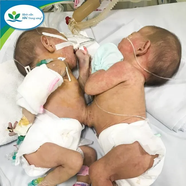 Cặp song sinh dính liền nhau hiếm gặp, khó khăn trong điều trị ảnh 1