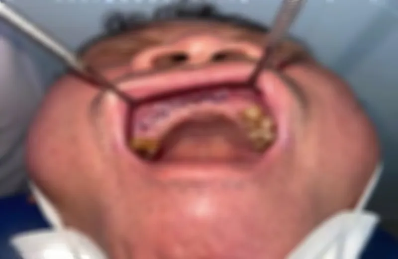 Phát hiện 2/3 ca hậu Covid-19 nhiễm nấm đen Mucormycosis gây tử vong do hoại tử xương  ảnh 2