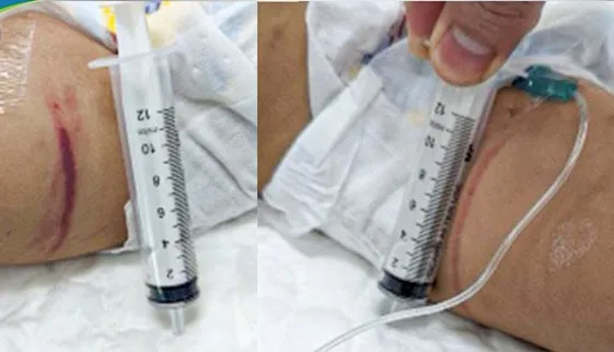 Bé gái 18 tháng tuổi bị bạo hành đã cai máy thở nhưng nhiều di chứng thần kinh ảnh 1