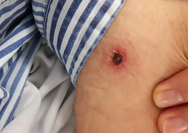 Liên tiếp phát hiện các trường hợp bị sốt mò có nguồn gốc lây từ chuột ảnh 3