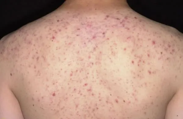 Trị mụn trứng cá ở lưng, một phụ nữ bị sốc phản vệ nguy kịch ảnh 1