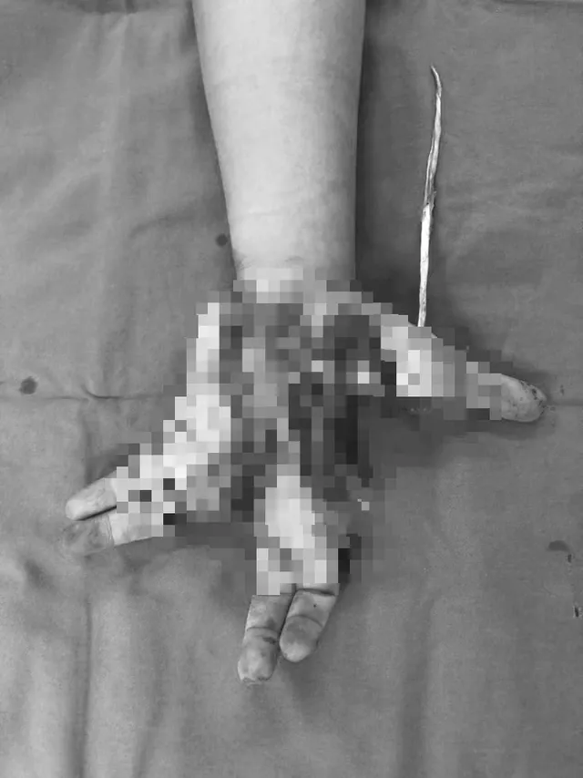 Bé trai 14 tuổi bị dập nát bàn tay do điện thoại phát nổ khi chơi game ảnh 1