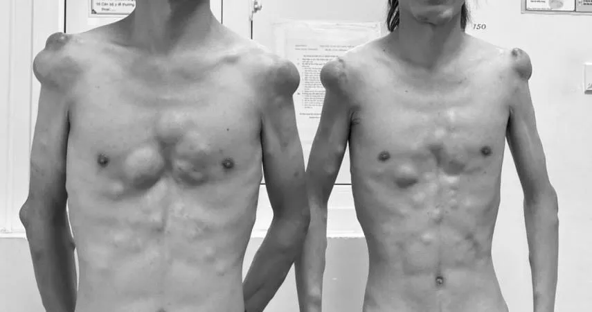 Phẫu thuật cho 2 anh em sinh đôi mắc bệnh hiếm gặp với hàng trăm khối u trên cơ thể ảnh 2