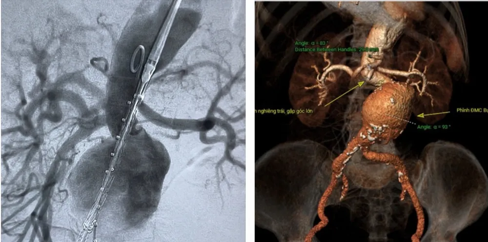 Động mạch chủ của bệnh nhân trước khi can thiệp