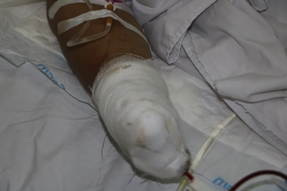 Cấp cứu bệnh nhân bị sốc đa chấn thương nặng do nổ mìn đánh cá ảnh 1