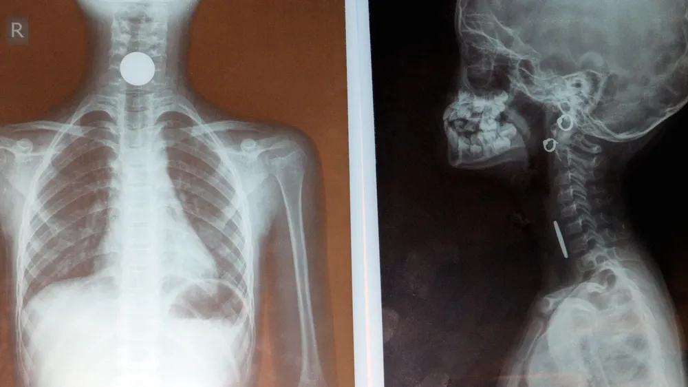 Hình chụp X-quang vùng cổ của cháu Ng.