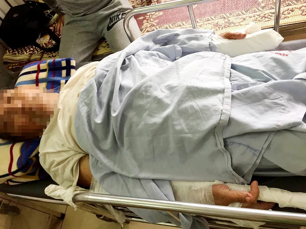 Đi thể dục buổi sáng làm chó sủa, cụ ông 83 tuổi bị đánh gãy 2 tay ảnh 2