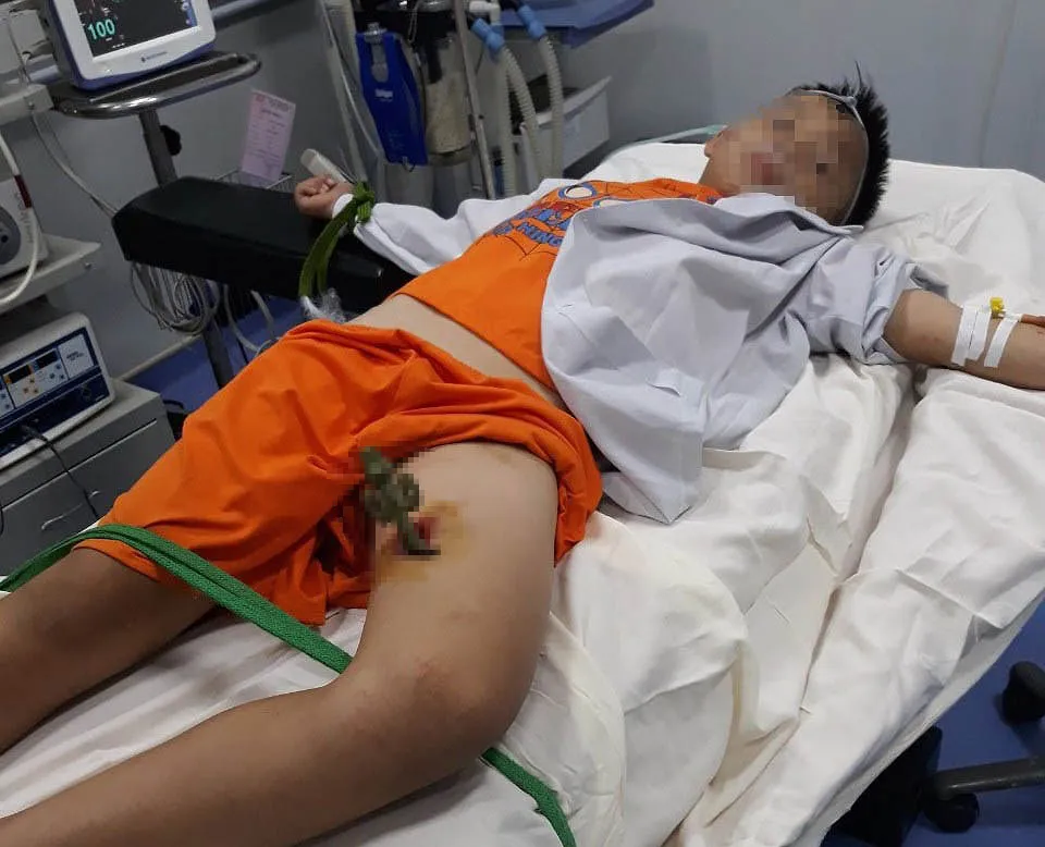 Mũi thanh sắt đâm vào đùi cháu Lê Văn Sáng