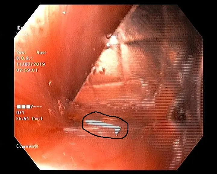 Nhập viện vì nuốt phải vỉ thuốc có cạnh sắc nhọn ảnh 1