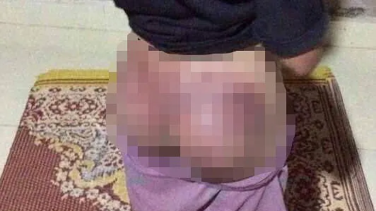 Cháu G. bị đánh bầm tím mông