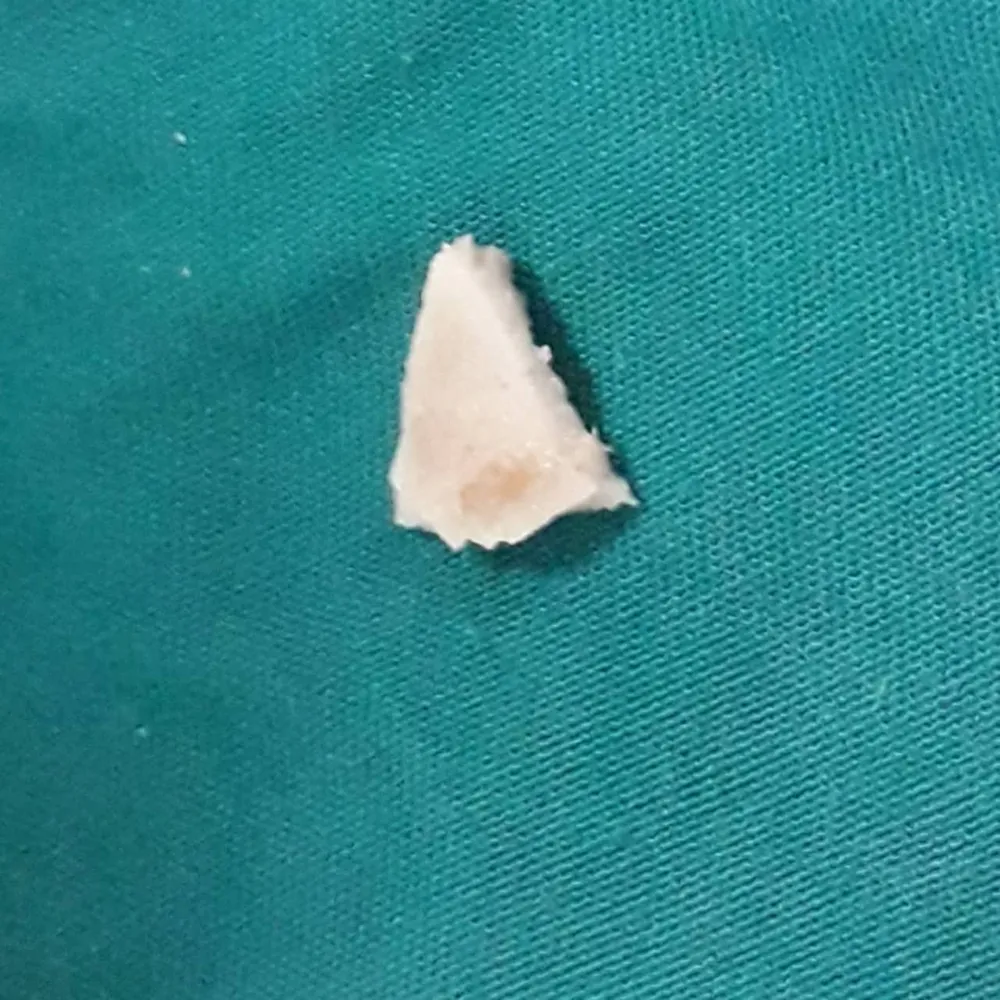 Gắp mảnh xương ở thanh quản bệnh nhi 19 tháng tuổi ảnh 1